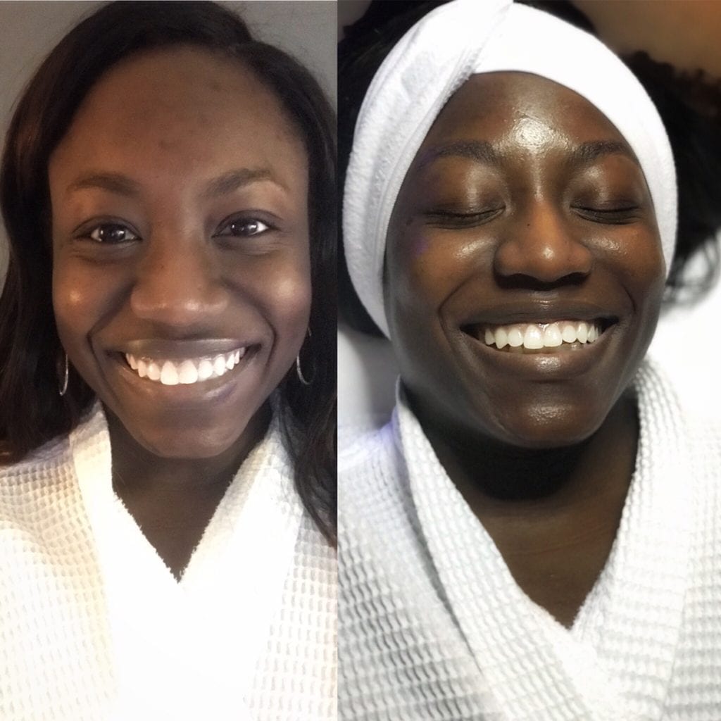 BEFORE and AFTER my hydrafacial! If you're looking for an acne treatment that helps deliver instant results, read my full review! 